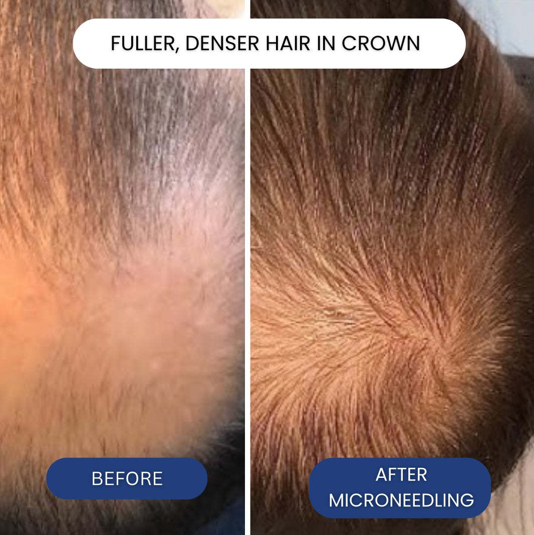 เซรั่มปลูกผม Microneedling GHK - Ingrown Hair Serum บทวิจารณ์และราคา